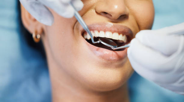 Best Knocked-Out Tooth (Avulsed Tooth) Treatment in Galesburg, IL